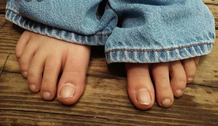 علامة مبكرة على القدمين لارتفاع مستوى الكوليسترول
