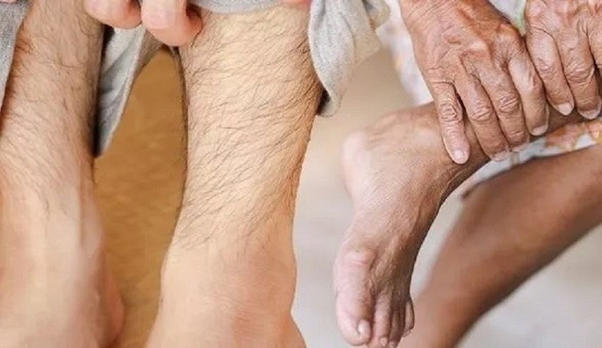 5 علامات على ساقيك تشير لارتفاع الكوليسترول!

