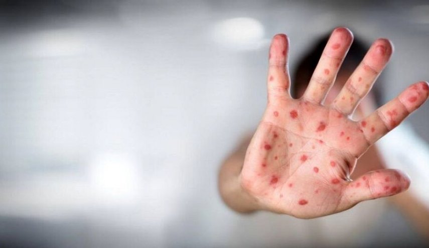 در صورتی که مشکوک به آبله میمونی شدیم چکار کنیم؟