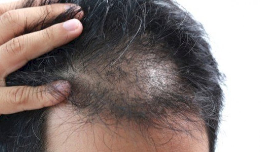 7 معلومات يمكن أن تكشفها حالة شعرك عن صحتك