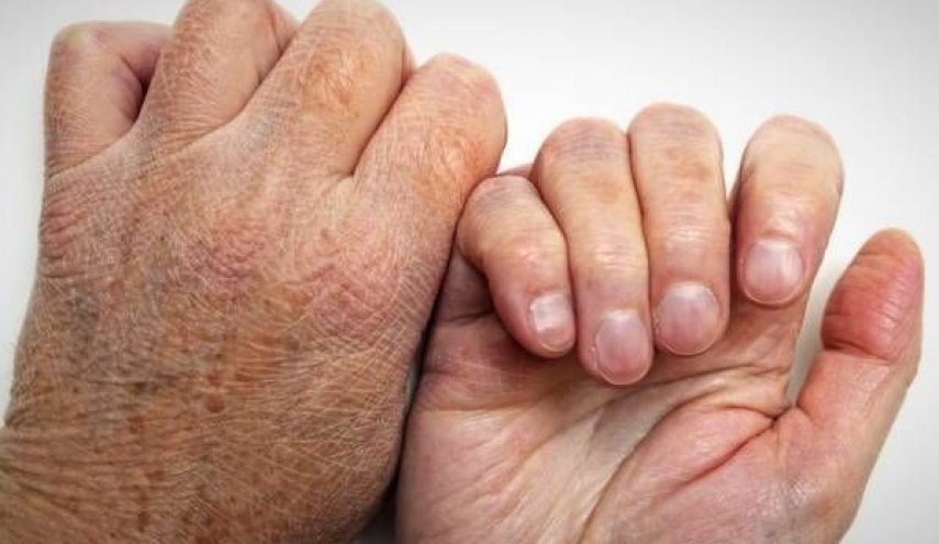 شناسایی بیش از ۱۱ هزار بیمار مبتلا به جذام در کشور/ جان باختن ۲ هزار و ۵۰۳ بیمار 