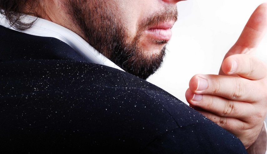 طرق طبيعية للتخلص من قشرة الشعر
